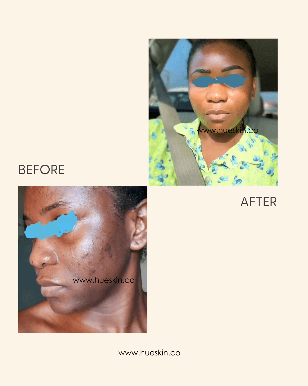 Before and after results showcasing skin improvement using VIVID GLOW GLOW BLACK SOAP DELUXE OFFER.