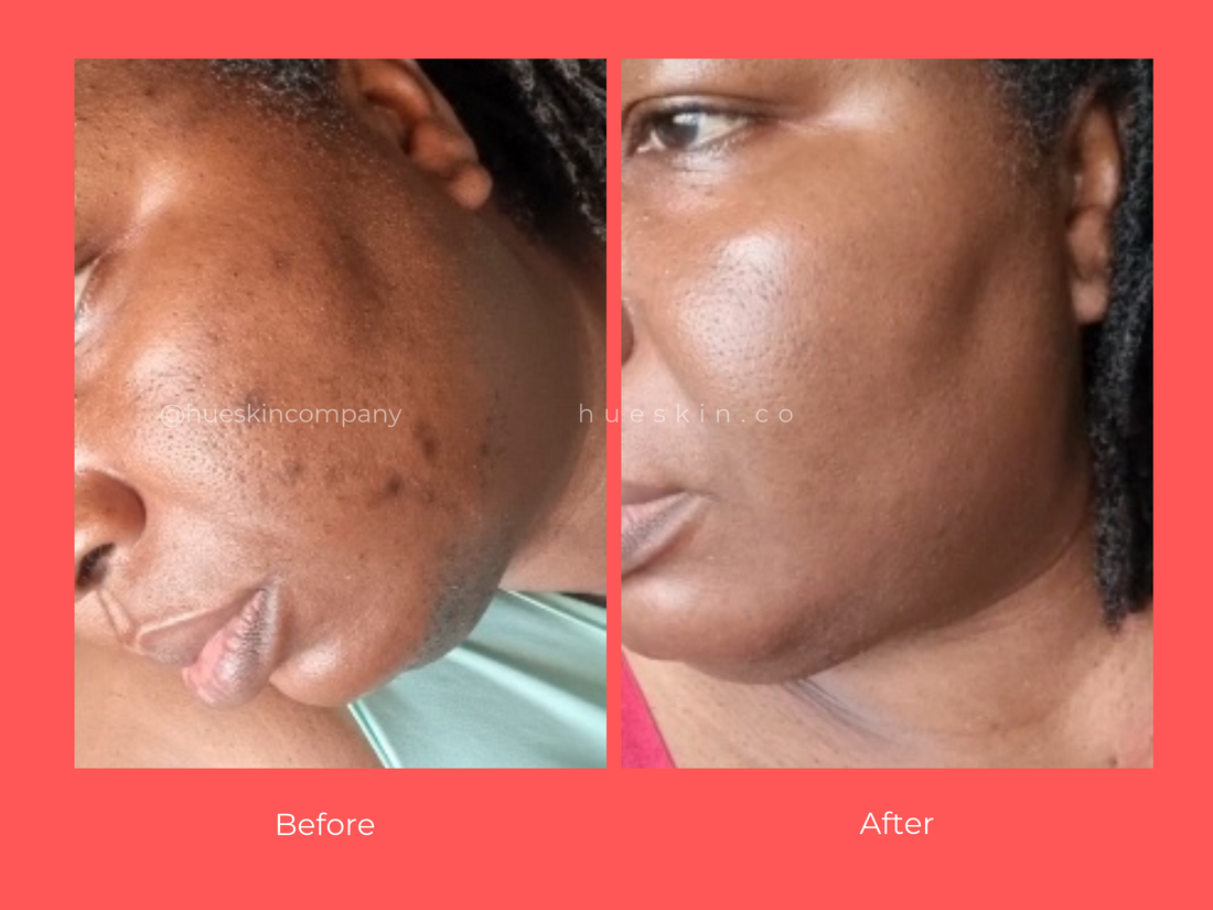 Healthy Skin Is Built, Not Rushed: Why Consistency Matters More Than Quick Fixes