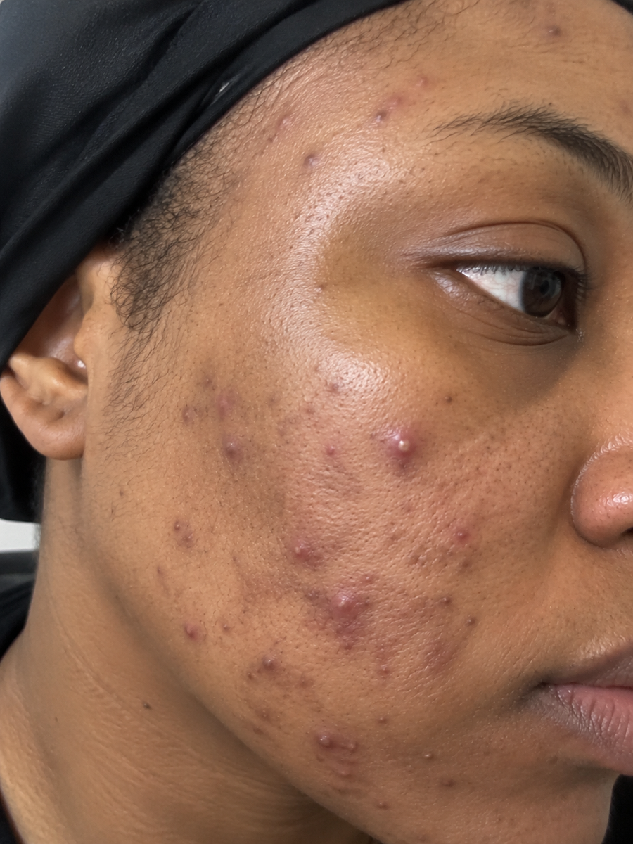 ACNE & BREAKOUTS