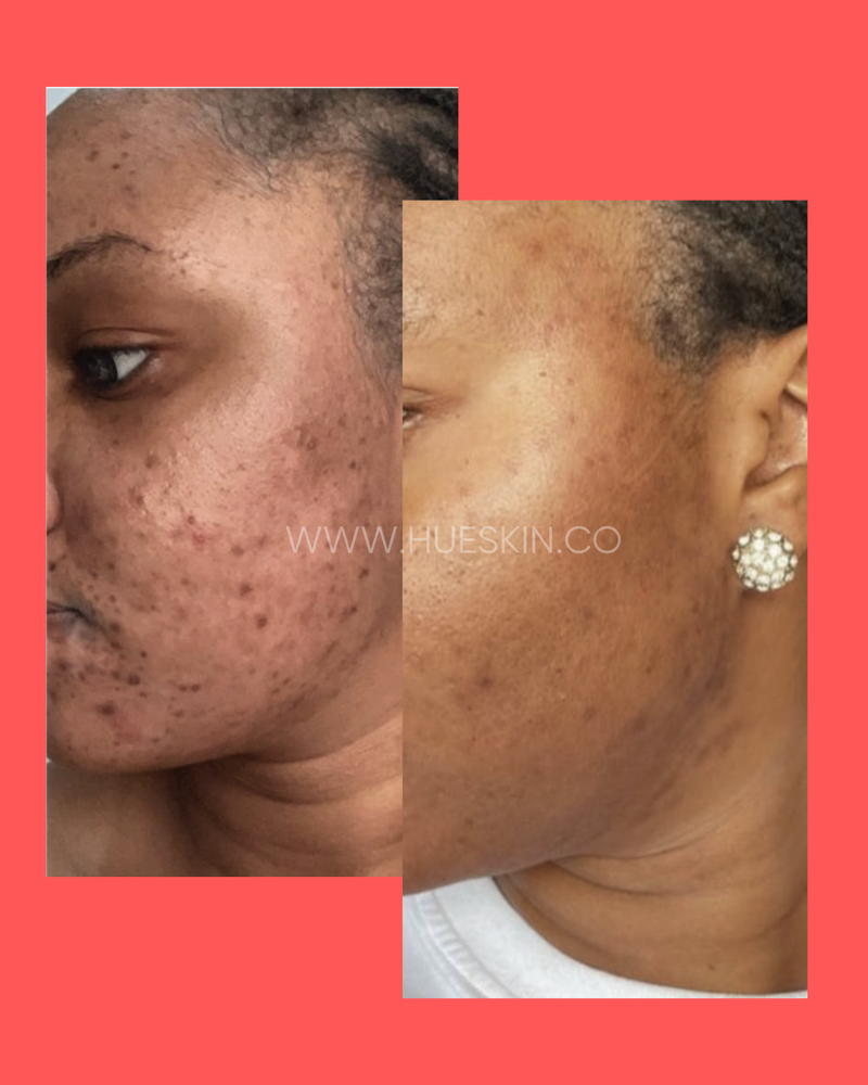 Dark Spots & Pigmentation
