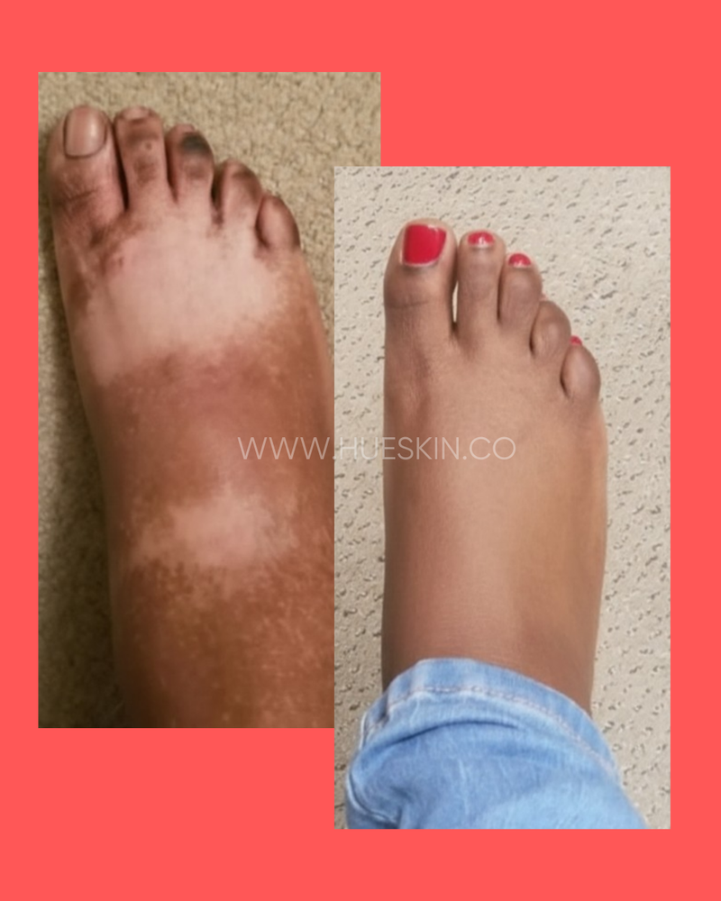 Uneven Skin Tone